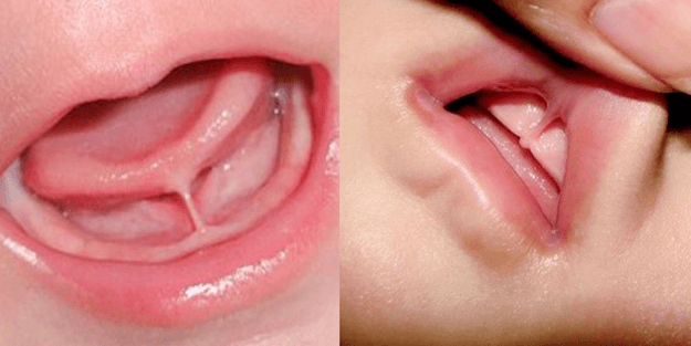 upper lip tie baby surgery